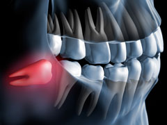 Wisdom Tooth Extraction