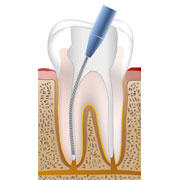 根管治療