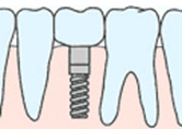インプラント
