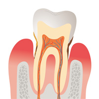 歯周病とは