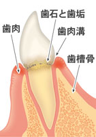 歯肉炎